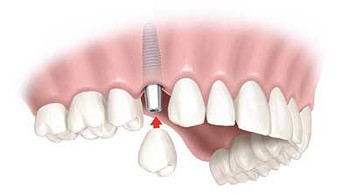 Implantologija nedostatak jednog zuba