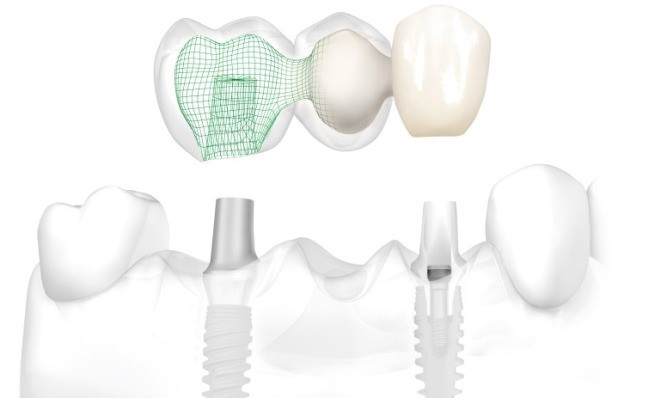 Implantologija nedostatak vise zubi