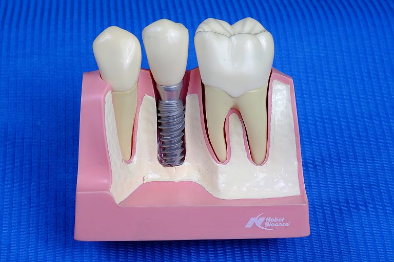 implantologija usluge dentalni implantanti
